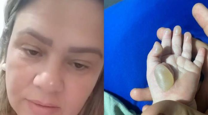 Revolta de pais: criança de 1 ano tem queimaduras de 2º grau dentro de creche em SC