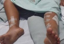 Criança de 9 anos é atacada por pitbull e passa por cirurgia após lesões graves no Oeste de SC