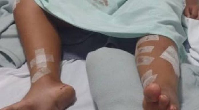 Criança de 9 anos é atacada por pitbull e passa por cirurgia após lesões graves no Oeste de SC