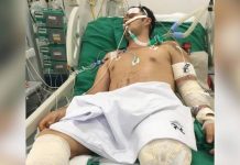 SOBREVIVENTE DE ATROPELAMENTO EM ITAPEMA LUTA PARA VOLTAR A ANDAR COM PRÓTESE DE ALTA TECNOLOGIA